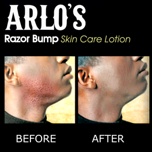 Arlo's Razor Bump Skin Care Lotion 6 oz